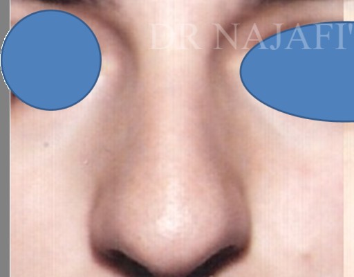Rhinoplasty before and after - before