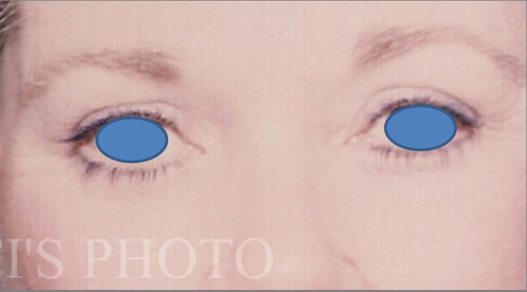 Blepharoplasty before and after - after