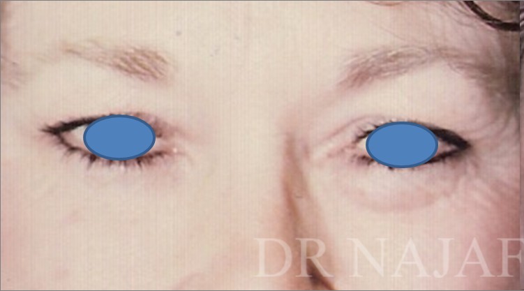 Blepharoplasty before and after - before