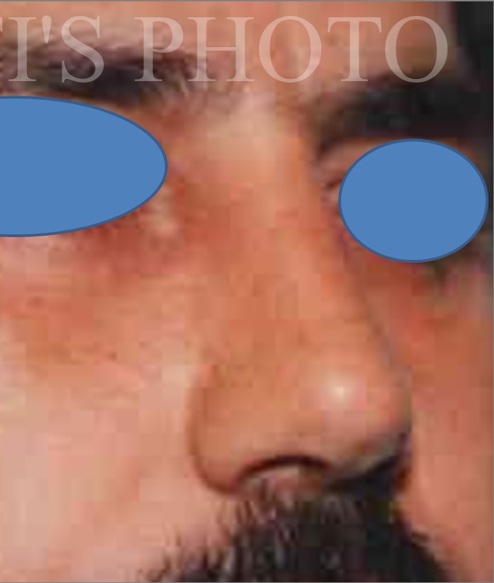 Rhinoplasty before and after - after