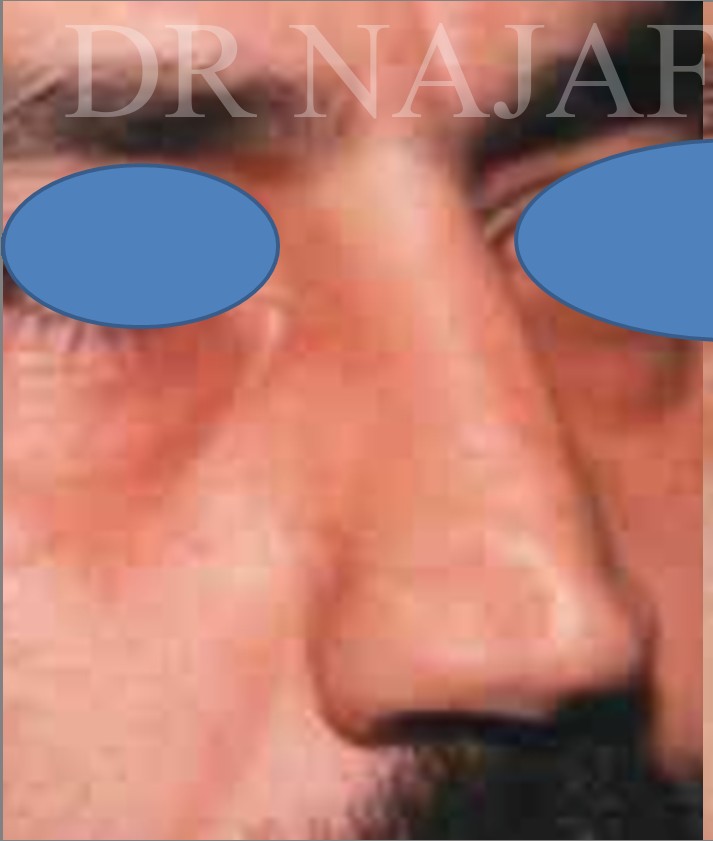 Rhinoplasty before and after - before