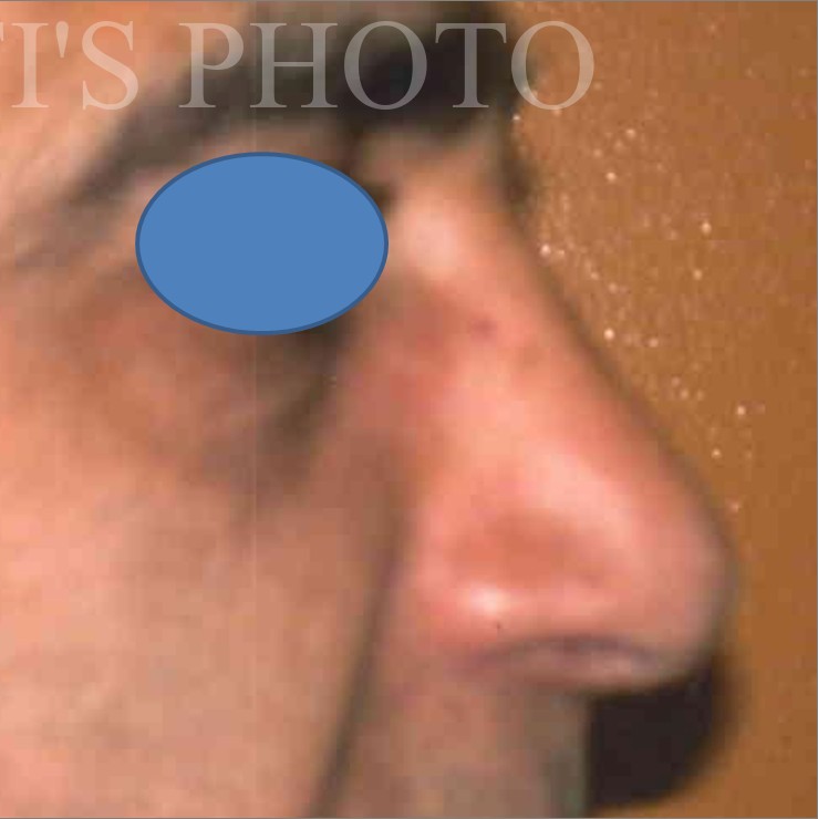 Rhinoplasty before and after - after