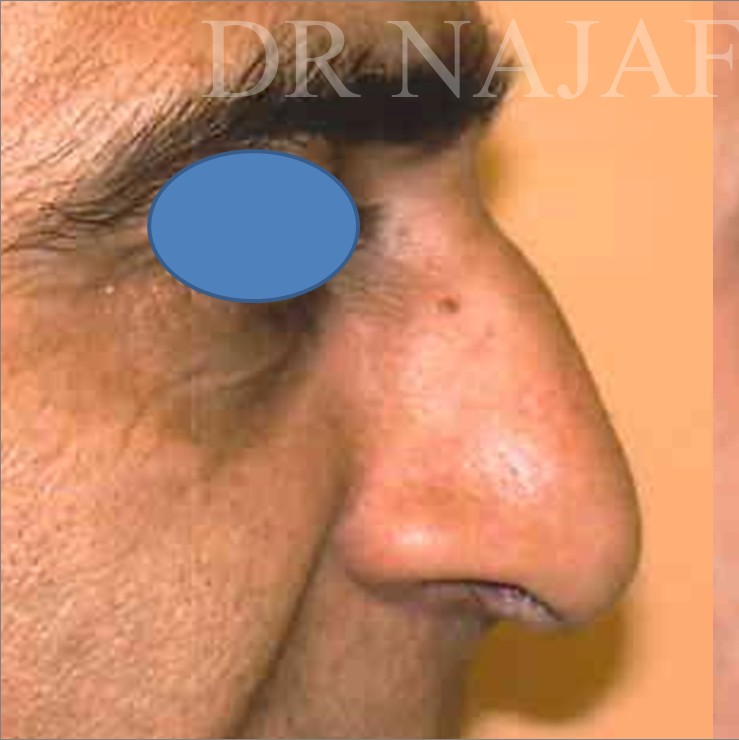 Rhinoplasty before and after - before