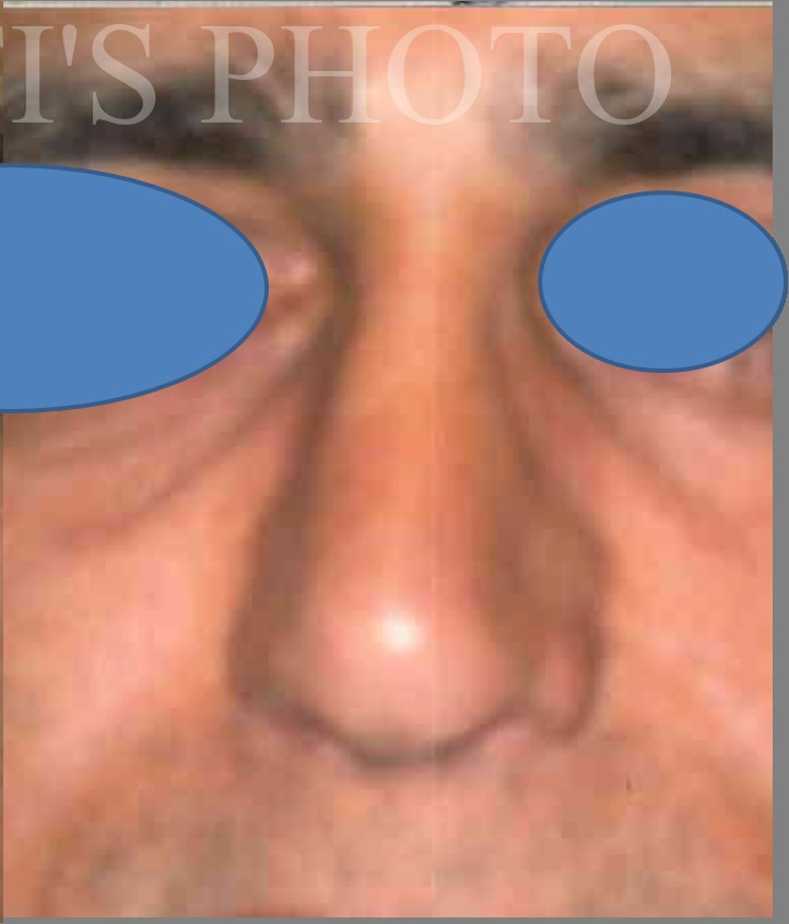 Rhinoplasty before and after - after