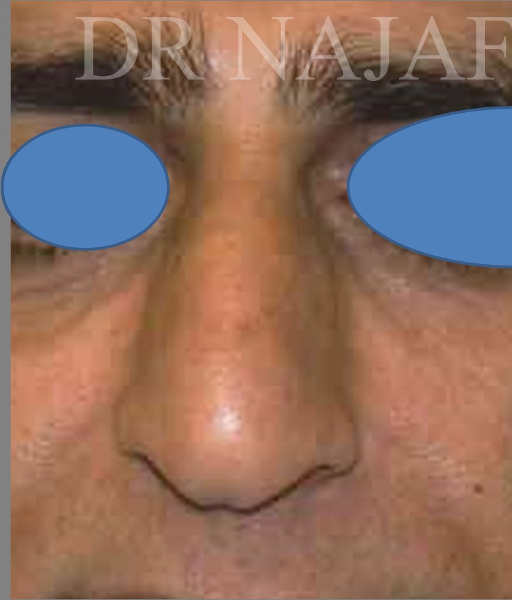 Rhinoplasty before and after - before