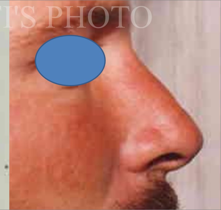 Rhinoplasty before and after - after