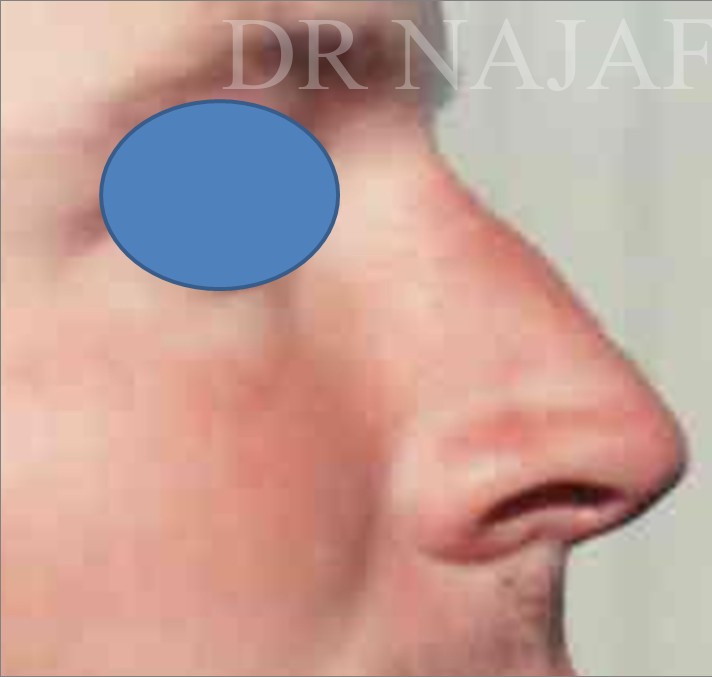 Rhinoplasty before and after - before