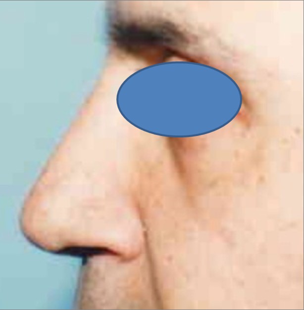 Rhinoplasty before and after - after