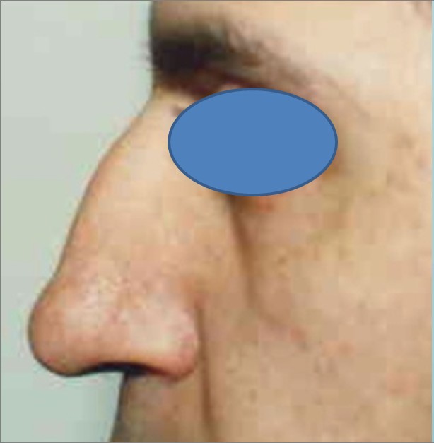 Rhinoplasty before and after - before