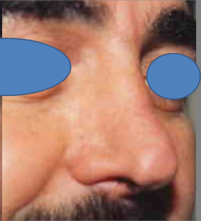 Rhinoplasty before and after - after