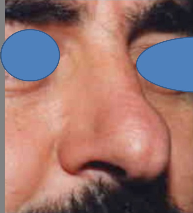 Rhinoplasty before and after - before