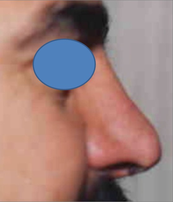 Rhinoplasty before and after - after