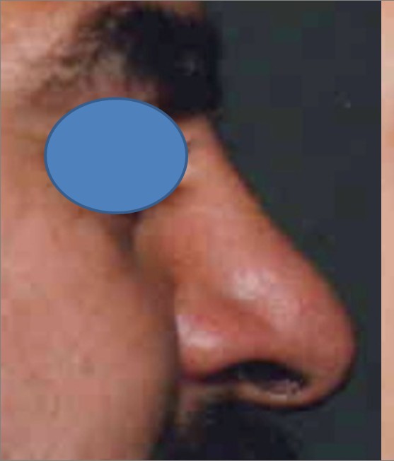 Rhinoplasty before and after - before