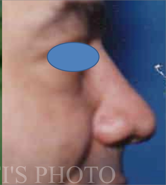 Rhinoplasty before and after - after