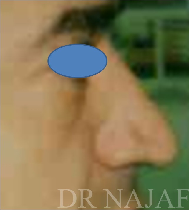 Rhinoplasty before and after - before