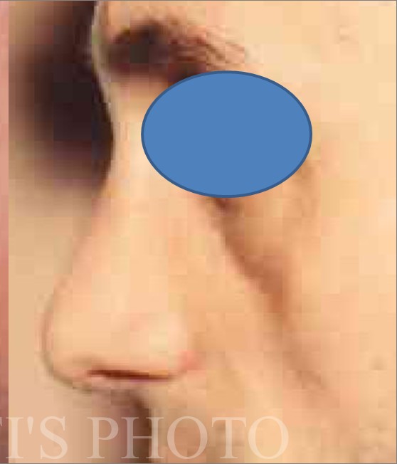 Rhinoplasty before and after - after