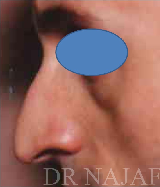 Rhinoplasty before and after - before