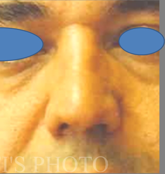 Rhinoplasty before and after - after