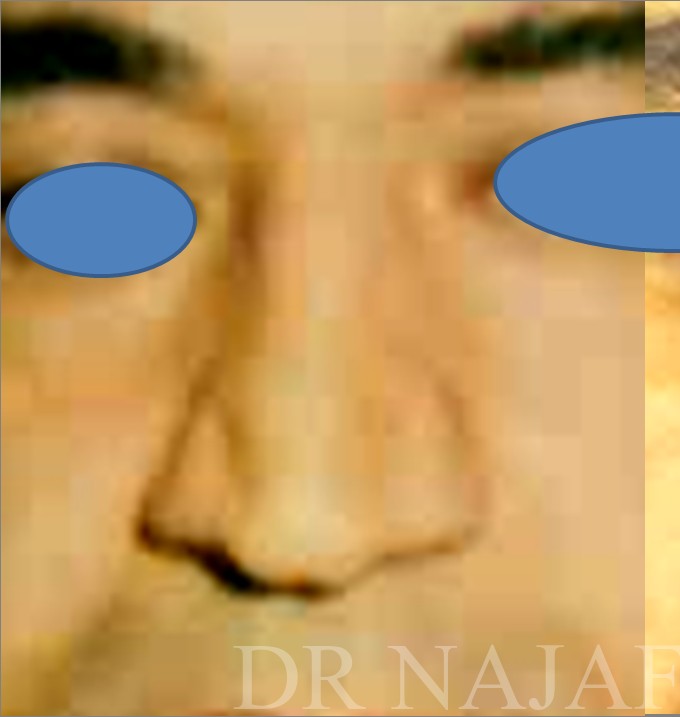 Rhinoplasty before and after - before