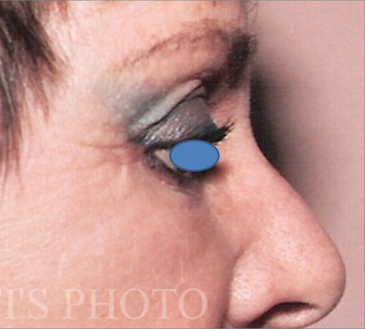 Blepharoplasty before and after - after