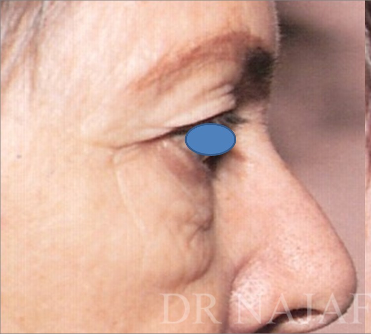 Blepharoplasty before and after - before