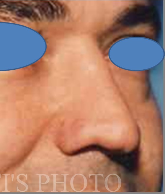 Rhinoplasty before and after - after