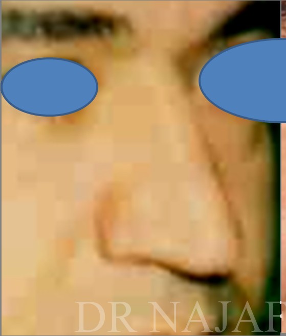 Rhinoplasty before and after - before