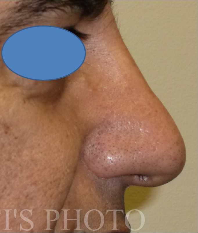 Rhinoplasty before and after - after