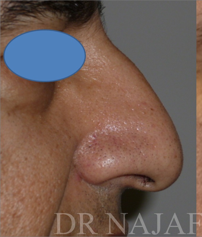 Rhinoplasty before and after - before