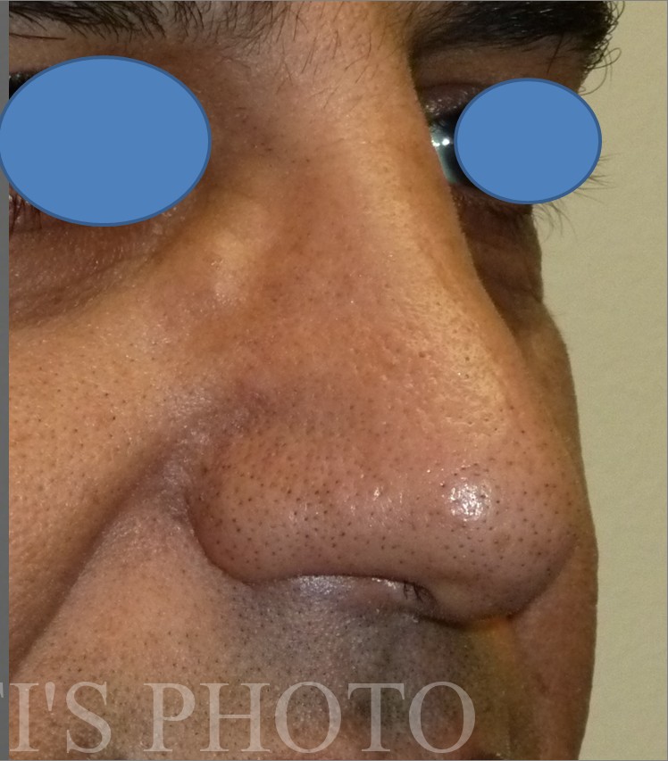 Rhinoplasty before and after - after