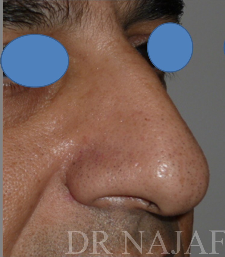 Rhinoplasty before and after - before