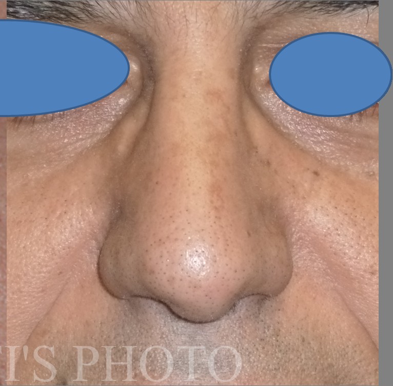 Rhinoplasty before and after - after