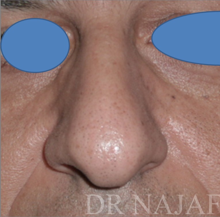 Rhinoplasty before and after - before