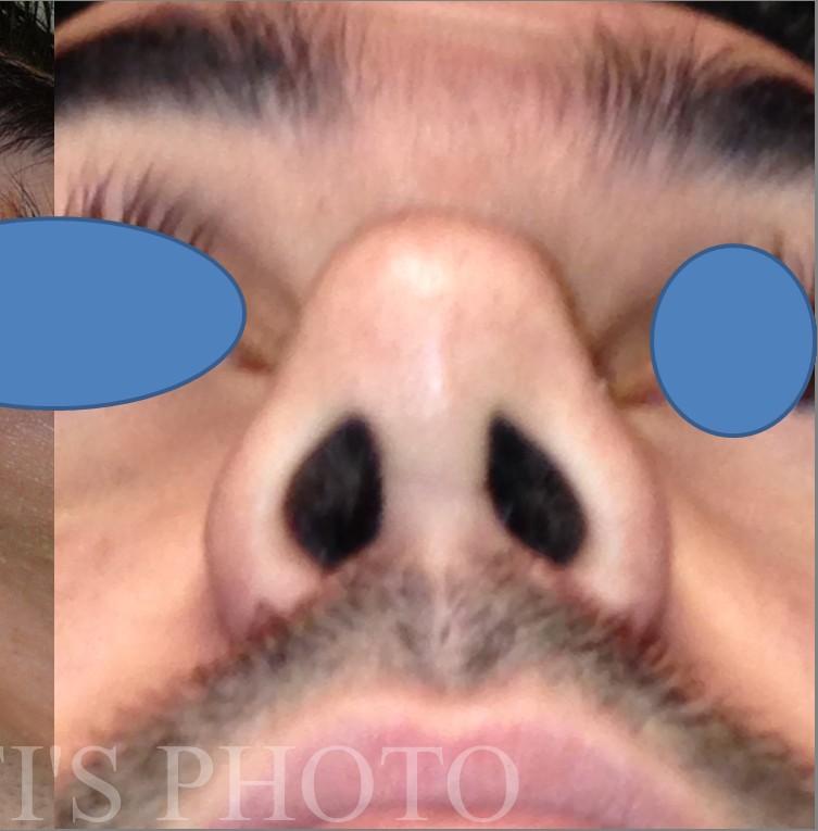 Rhinoplasty before and after - after