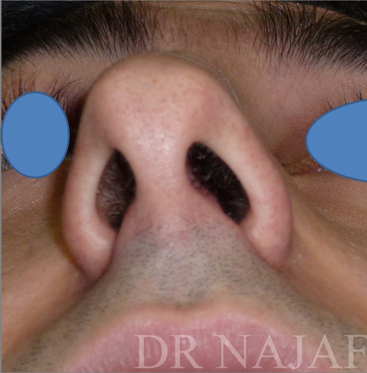 Rhinoplasty before and after - before