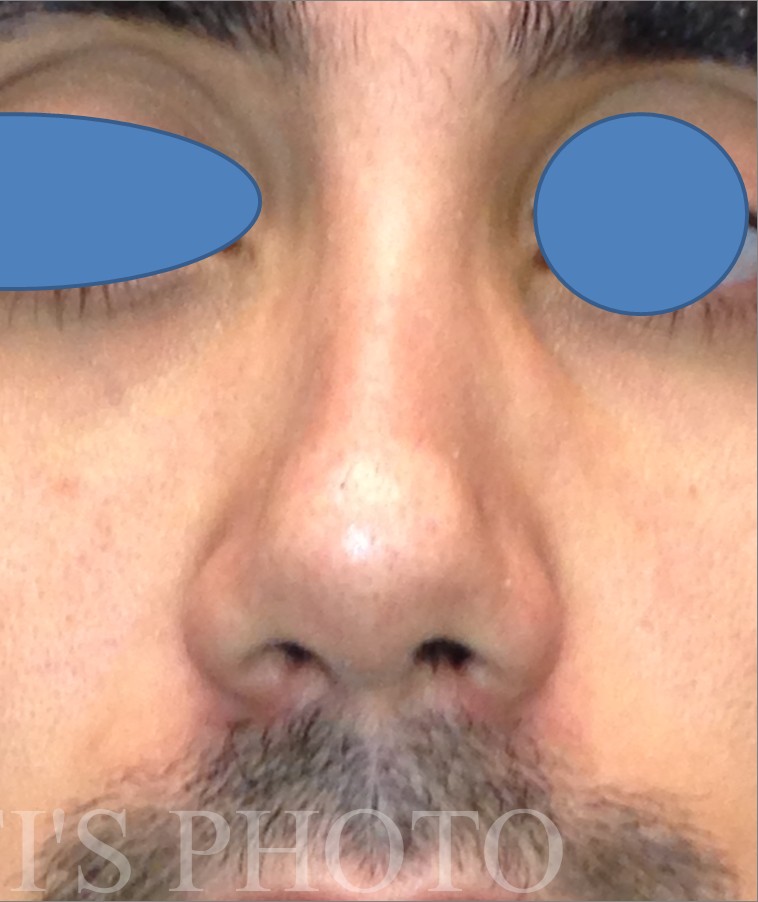 Rhinoplasty before and after - after