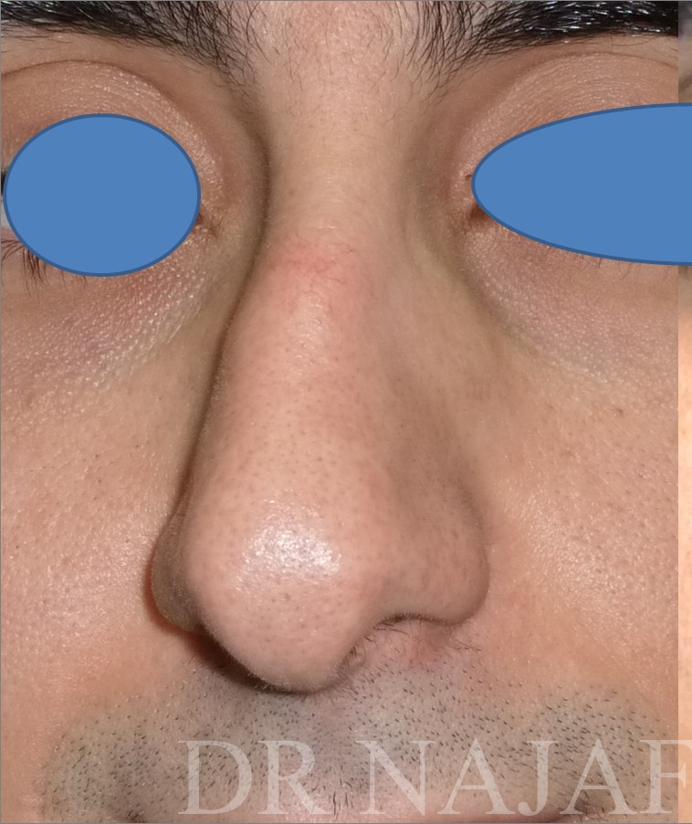 Rhinoplasty before and after - before