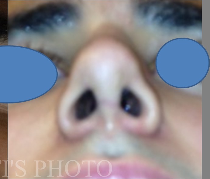 Rhinoplasty before and after - after