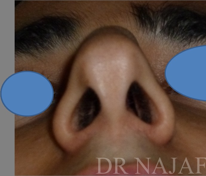 Rhinoplasty before and after - before