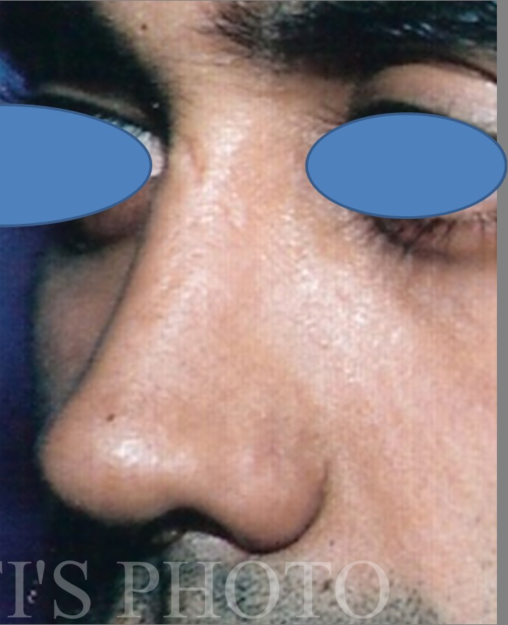 Rhinoplasty before and after - after