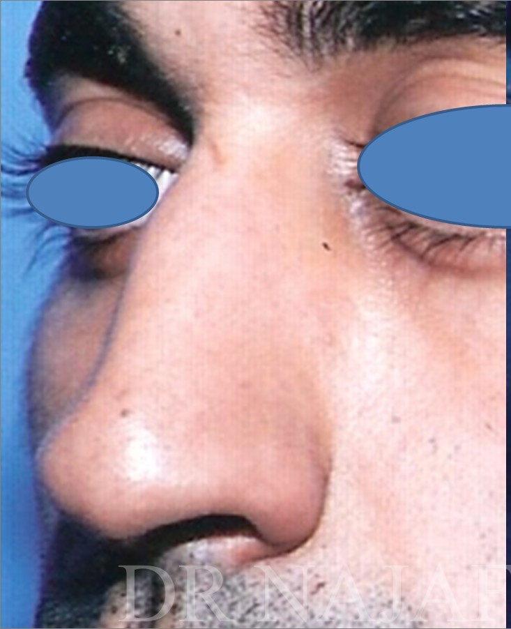 Rhinoplasty before and after - before