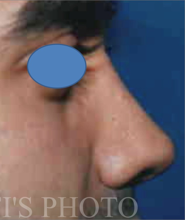Rhinoplasty before and after - after