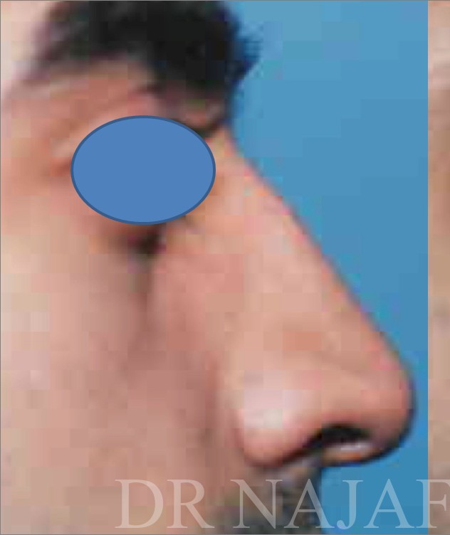 Rhinoplasty before and after - before