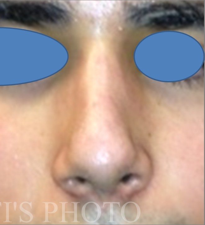 Rhinoplasty before and after - after
