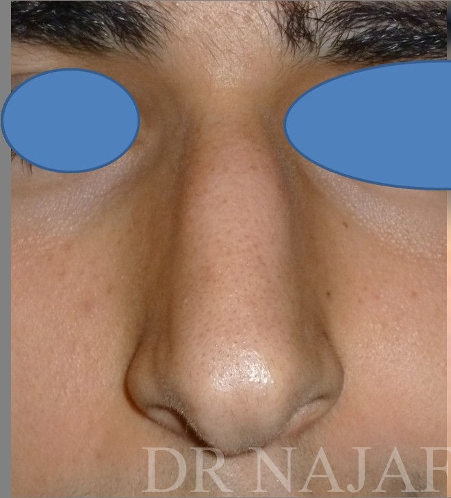 Rhinoplasty before and after - before
