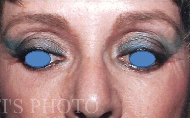 Blepharoplasty before and after - after