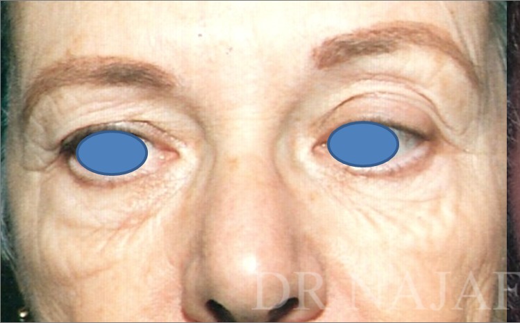 Blepharoplasty before and after - before