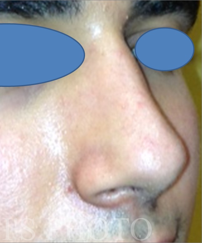Rhinoplasty before and after - after