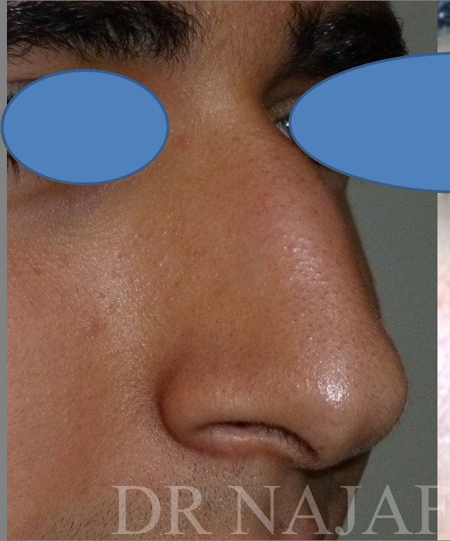 Rhinoplasty before and after - before