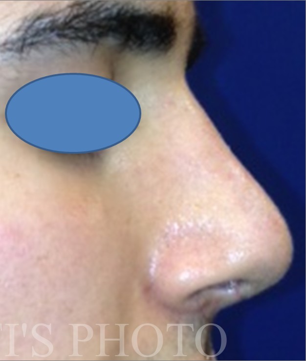 Rhinoplasty before and after - after